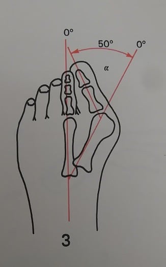 Bunion Foot Pain