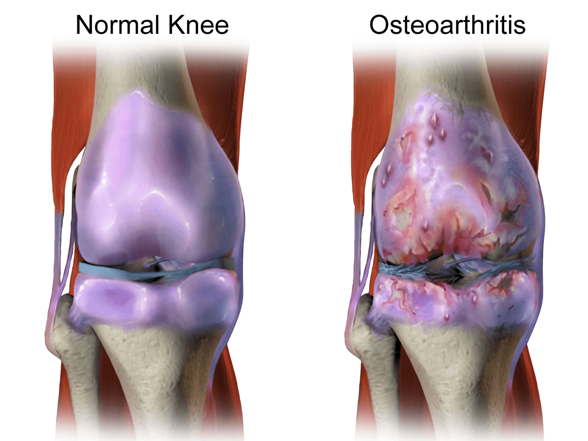 Knee Osteoarthritis