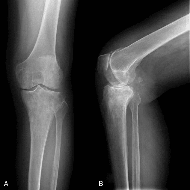 Knee xray