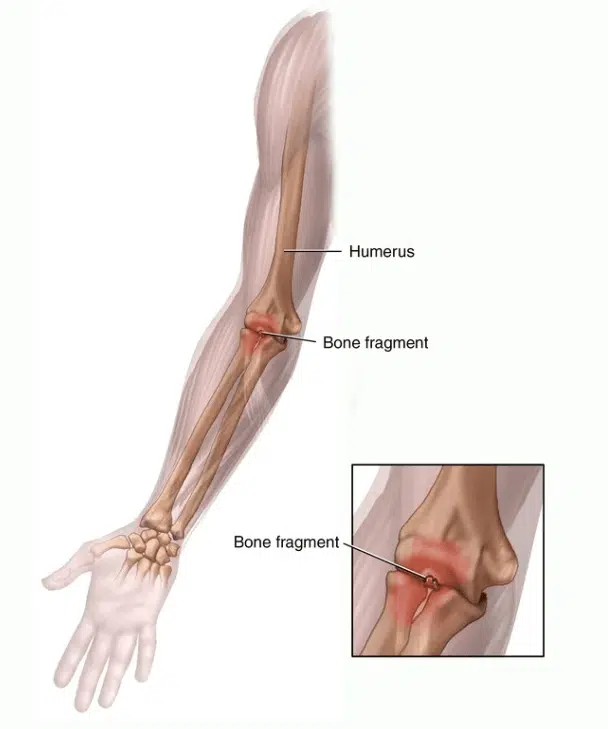 Little league elbow