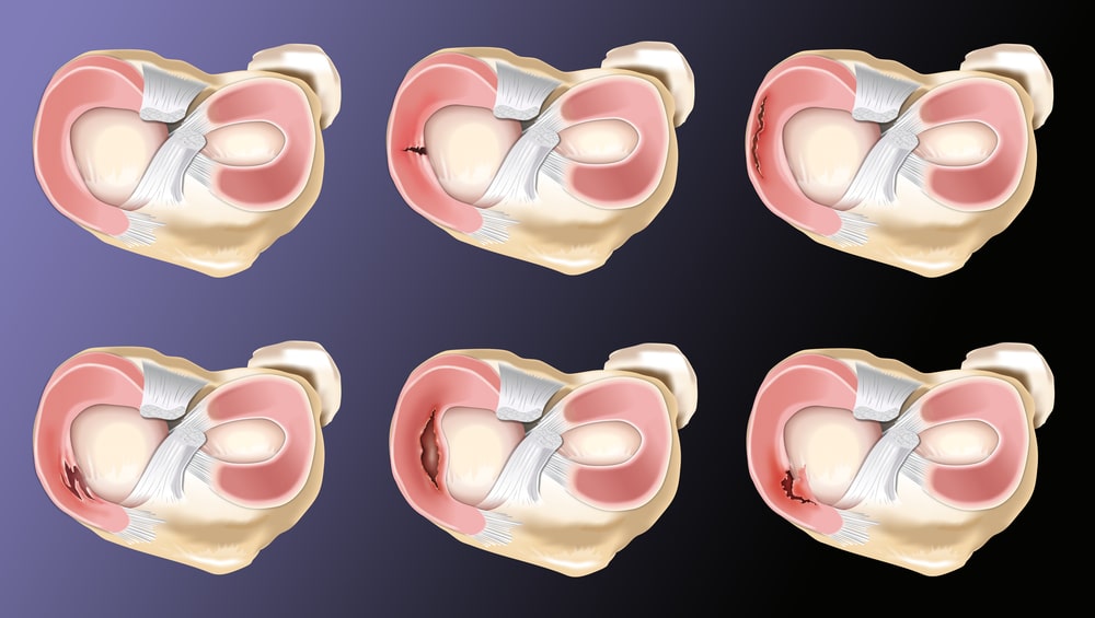 Meniscal Tear