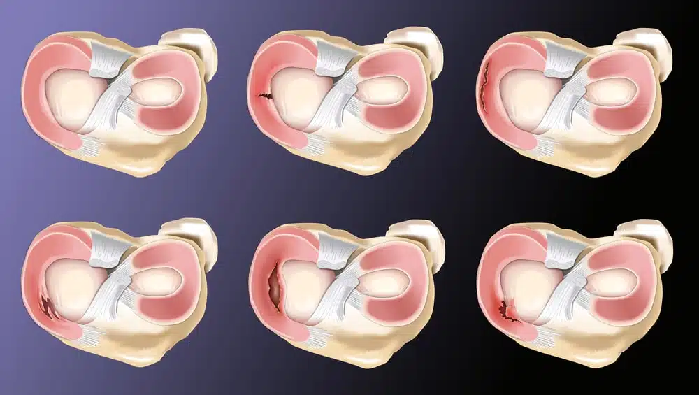 Meniscal Tear