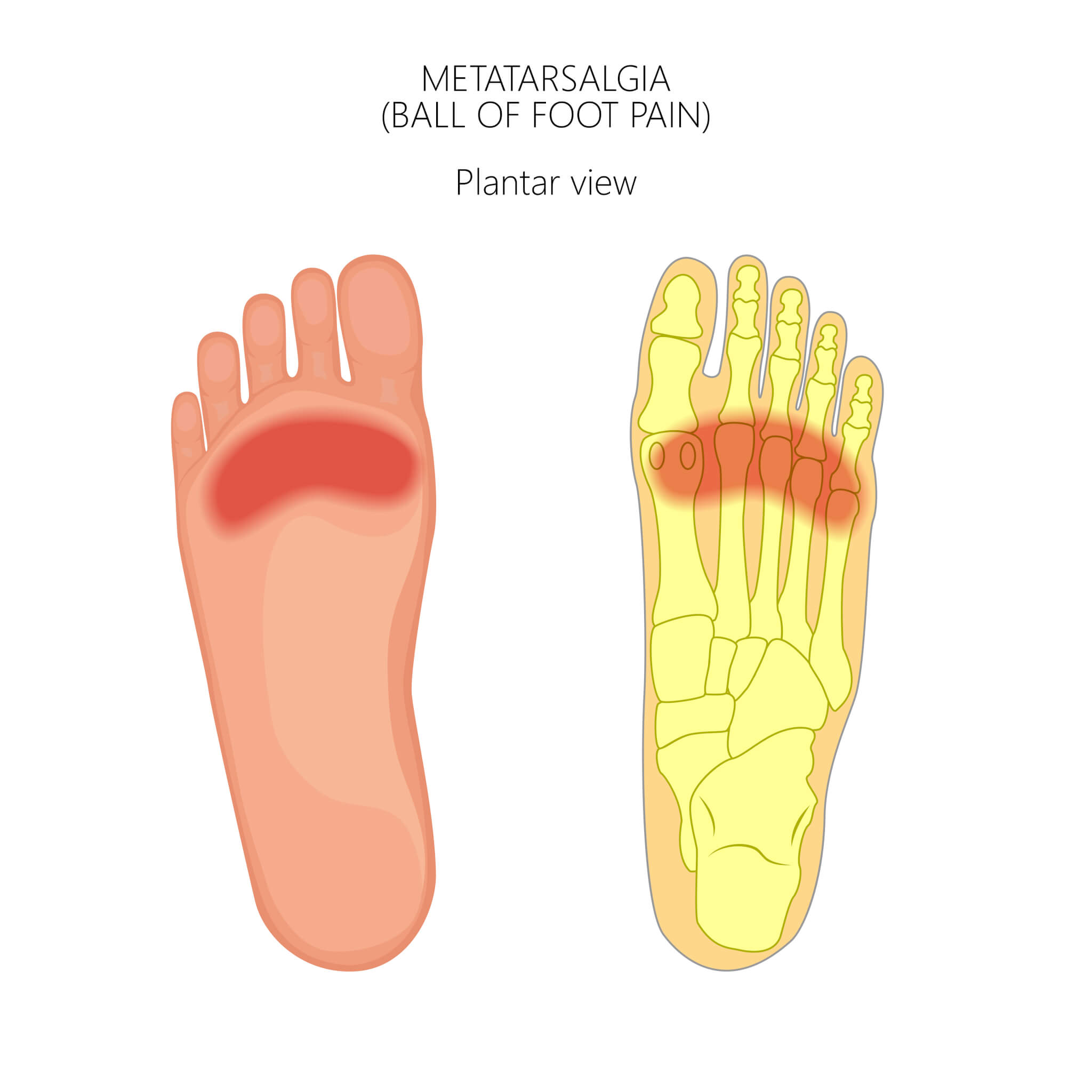 Metatarsalgia Foot Pain