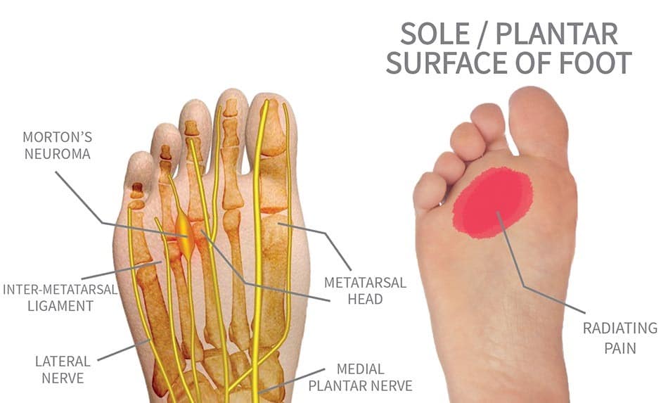 Mortons Neuroma Foot Pain