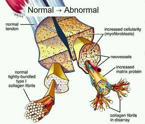 Tendonitis Foot Pain