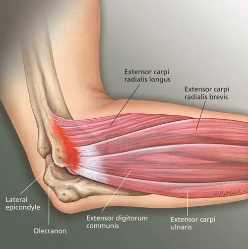 Tennis Elbow