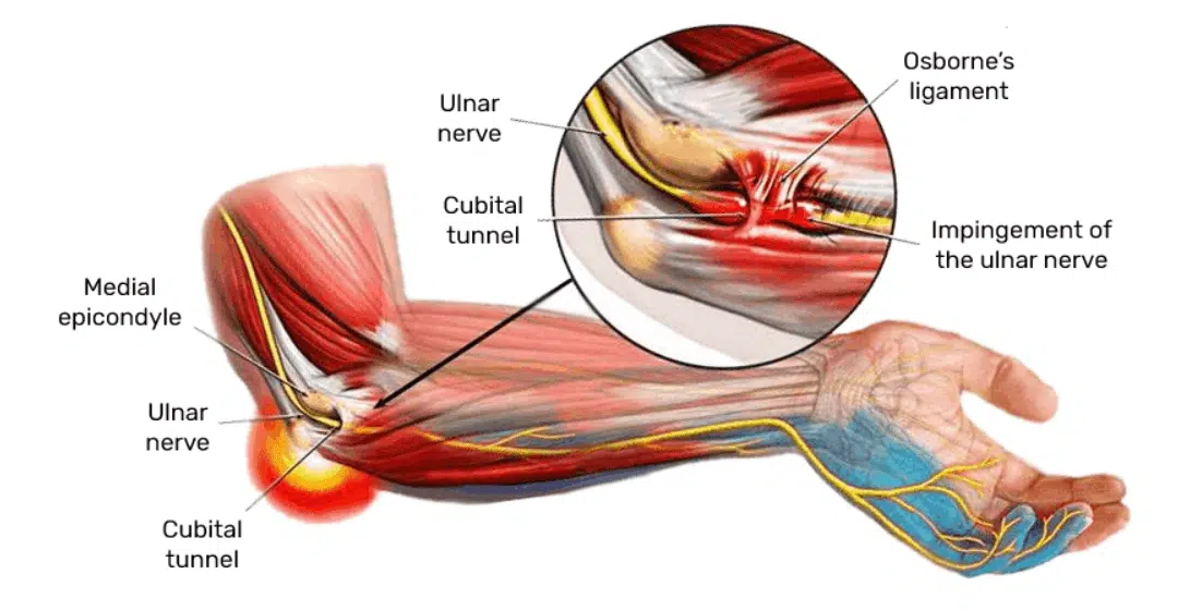 cubital tunnel syndrome