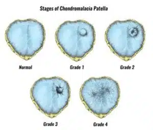 knee condition